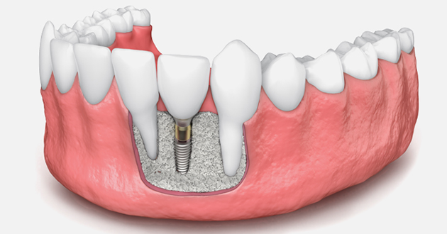 dental fillings lancaster tx