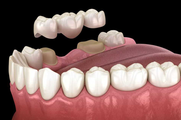 dental fillings lancaster tx