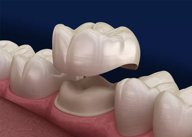 dental fillings lancaster tx