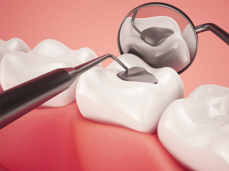 dental fillings lancaster tx