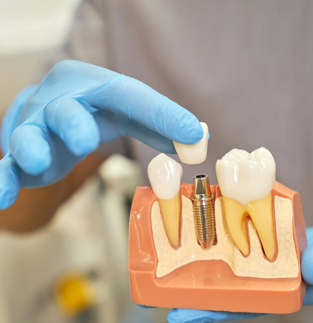dental fillings lancaster tx