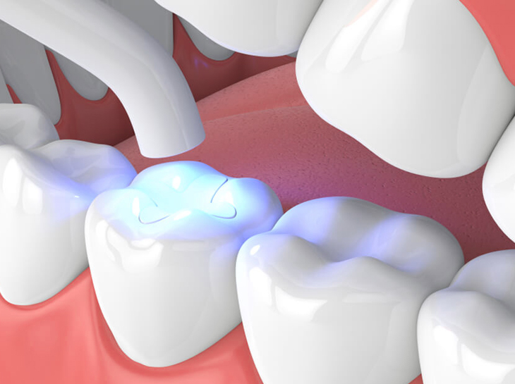 dental fillings lancaster tx
